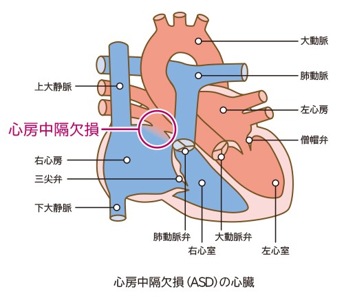 心房中隔欠損の心臓図