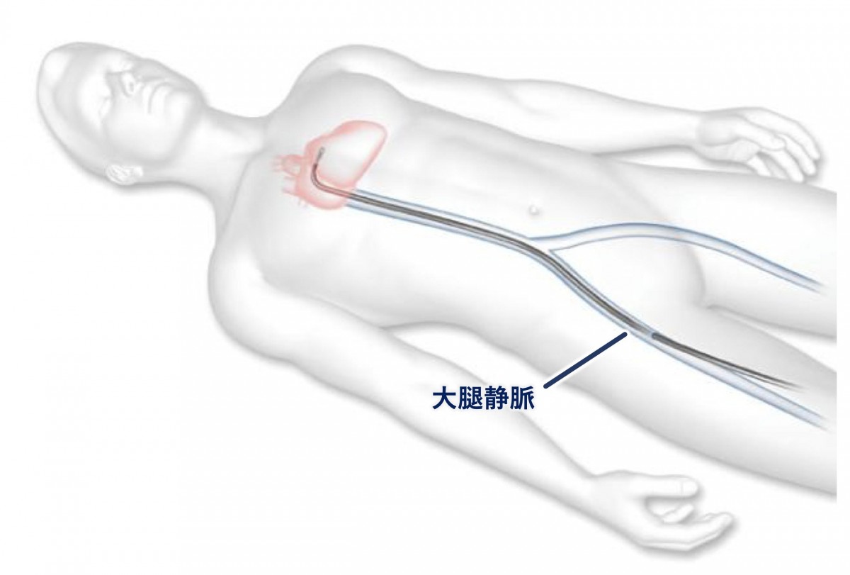 経皮的僧帽弁クリップ術による治療の流れ フローイメージ図